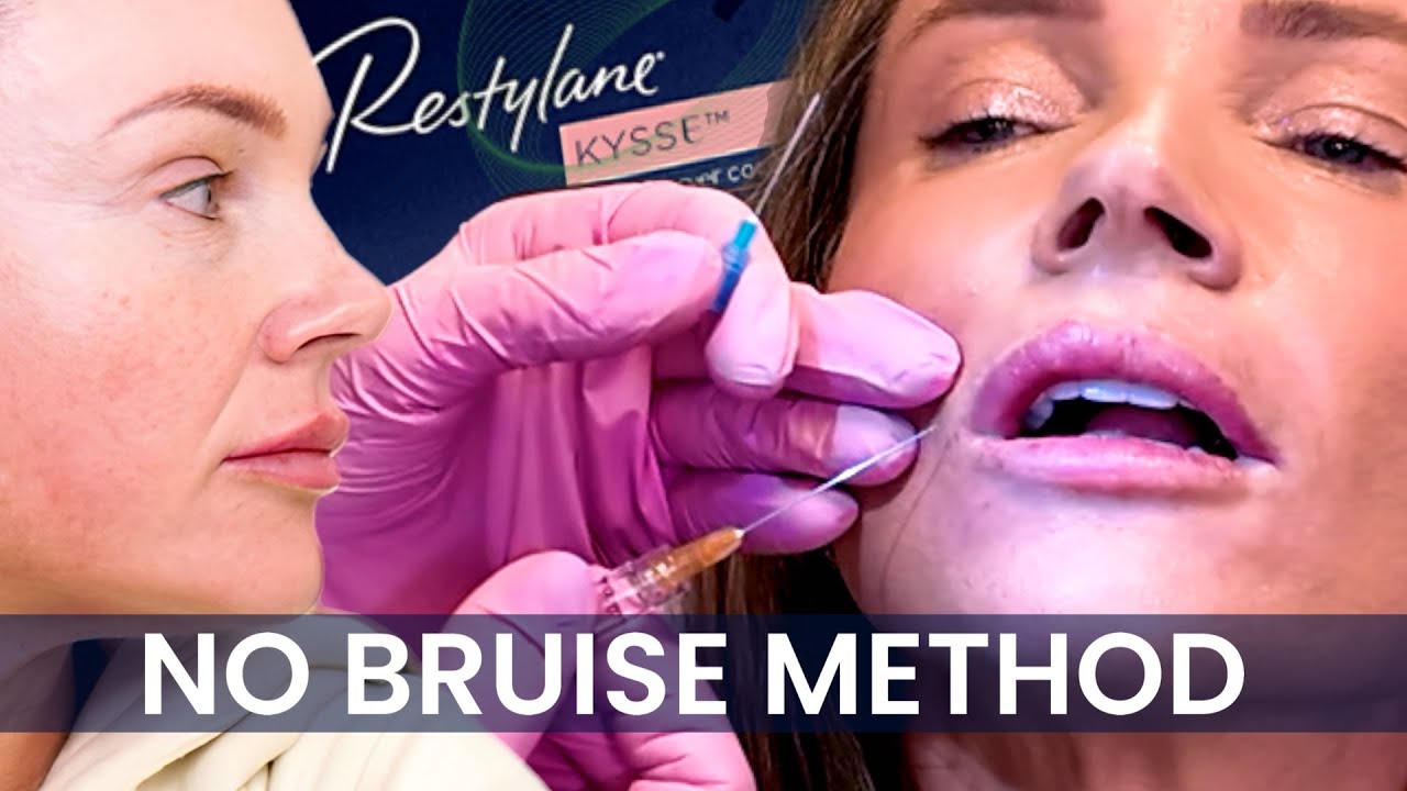 Филлер для губ Restylane Kysse: почему канюльная техника меняет правила игры!