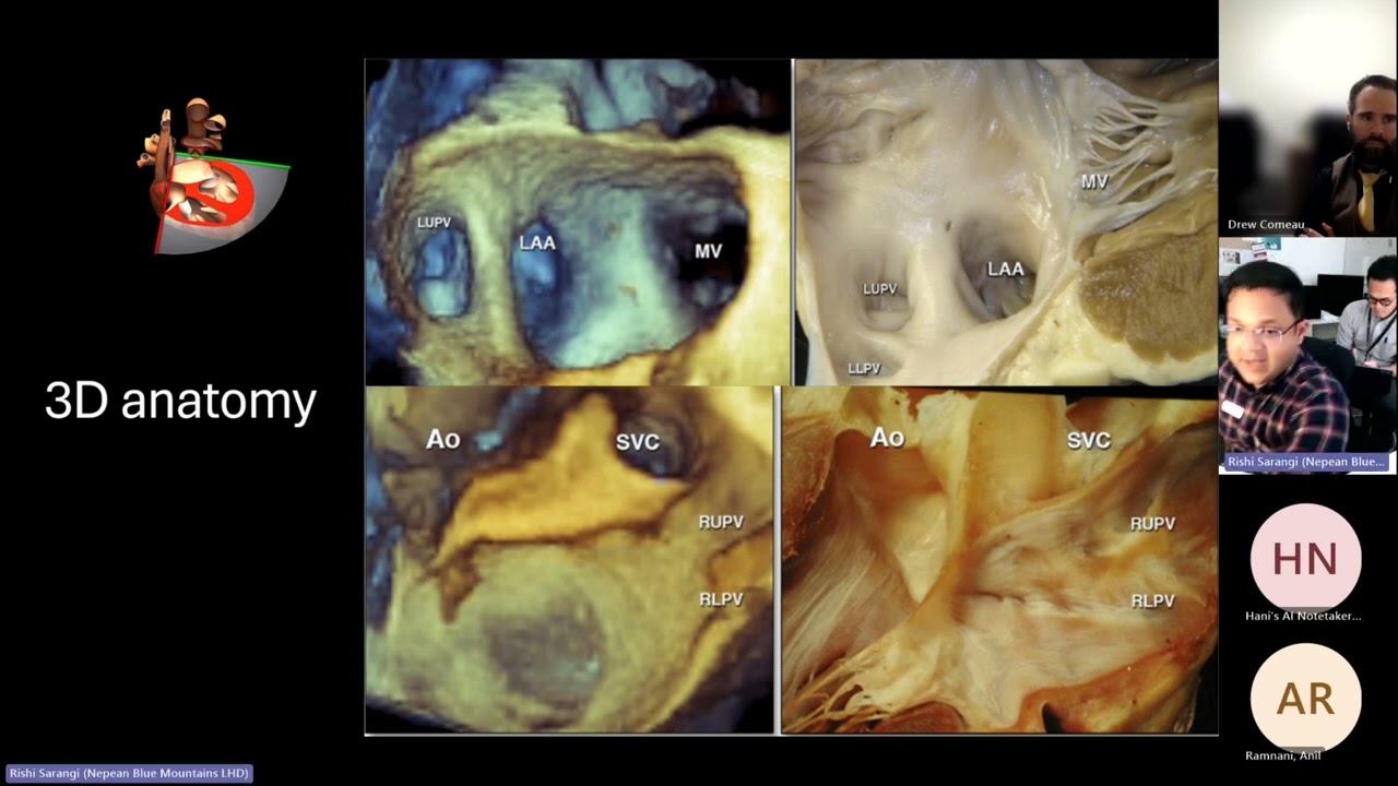 Pulmonary Vein assessment