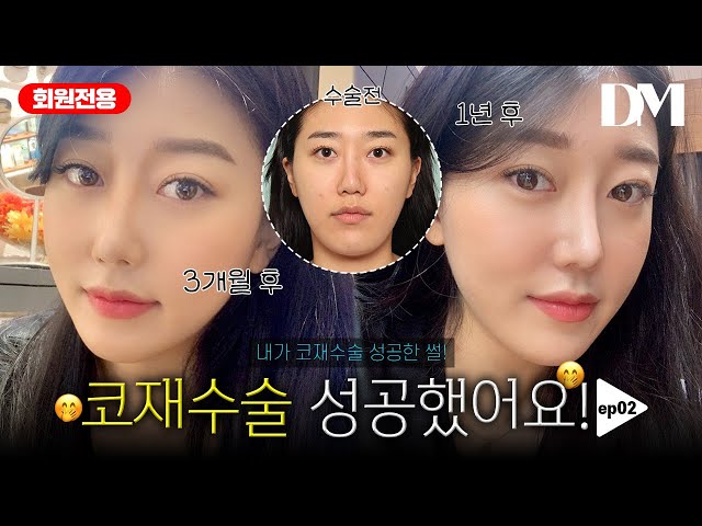 코 재수술 리얼 후기 2탄 보기만 해도 스트레스 받았던 내코 명품코 되다  ㅣ압구정 디엠성형외과