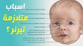 اسباب متلازمة تيرنر واساليب وطرق علاجها