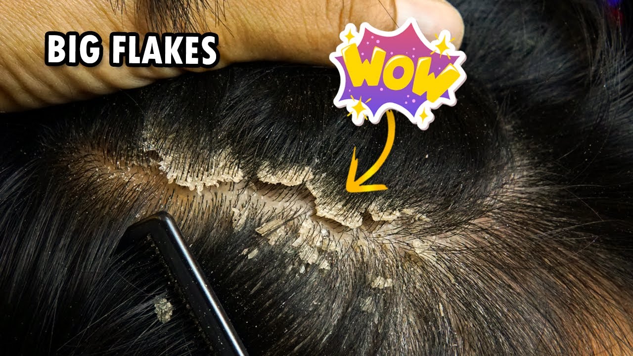 Psoriasis Itchy Scalp Scratching!!! Dandruff Removal Satisfying 317