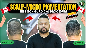 SCALP MICRO PIGMENTATION Changed My Life!