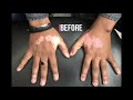 Vitiligo Or Leucoderma Treatment Micro Pigmentation In India Safed Daag Ka Ilaaj Vitiligo On Hand