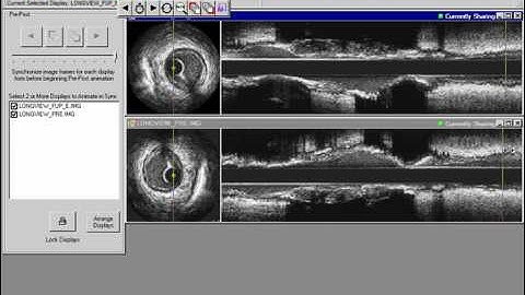 MIB: IVUS Lab Pre and Post Demo