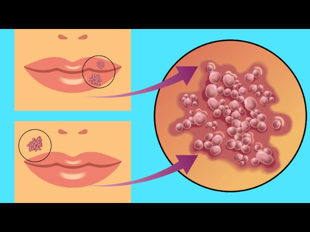 Labial dia un quitar herpes en