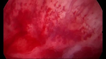 Endoscopic view of the bladder during hydrodistension in an IC/BPS patient