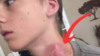 Teen Wakes In Agony During Sleepover, Notices Bad Burns On His Neck.