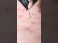 毛抜き#hairremoval #blackheads #plucking #tweezers #ingrownhair