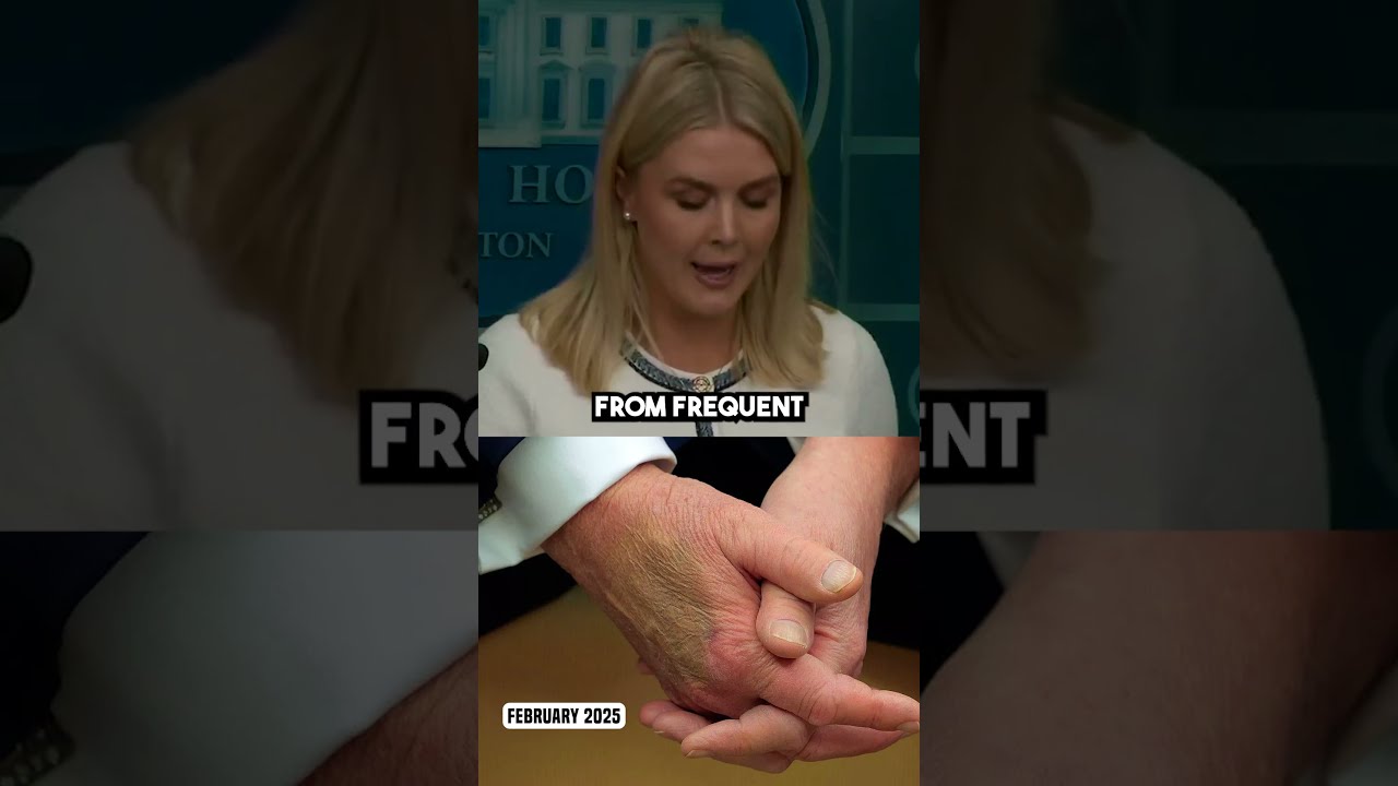 Karoline Leavitt RESPONDS To Trump S Bruises Shorts