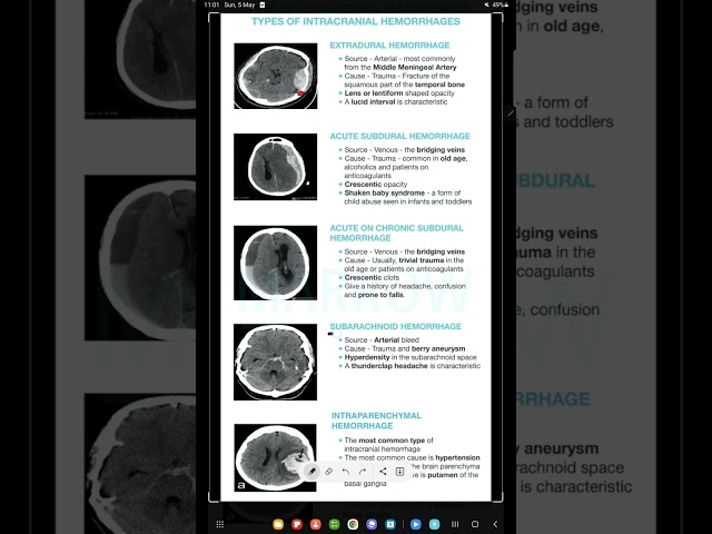 tricks by uday - radiology 1 (intracranial hemorrhage) #radiology class=