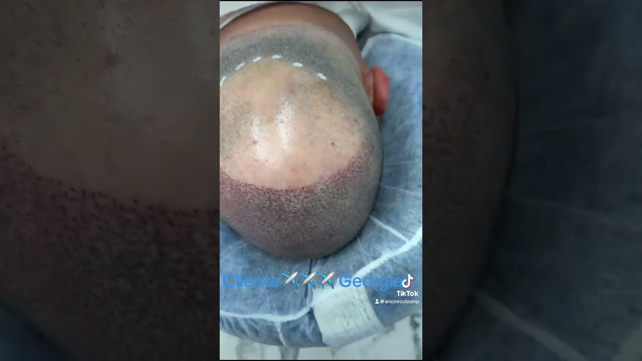 SMP instant results For free consultation and quote send pictures call or text at 954-604-5882 ￼