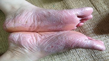 Thuốc chữa Viêm da cơ địa á sừng chỉ đơn giản từ quả trứng, da trắng mịn như da em bé