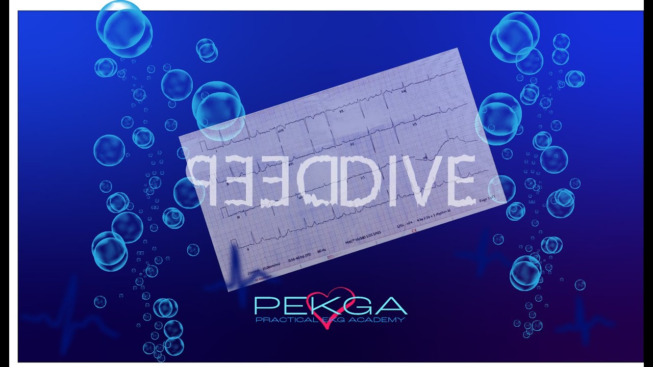 ATRIAL FLUTTER - DEEP DIVE - PEKGA