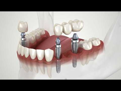 Video Before Getting Dental Implants Watch This | Dental Implant Procedure
