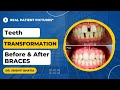 Teeth TRANSFORMATION Before and After Braces: Dr. Srishti Bhatia