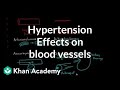 Hypertension effects on the blood vessels | Health & Medicine | Khan Academy