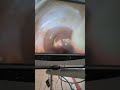 IOL Placement in Bag #ophthalmology #eyes #eyecare #intraocular lens #cataract surgery  #phaco