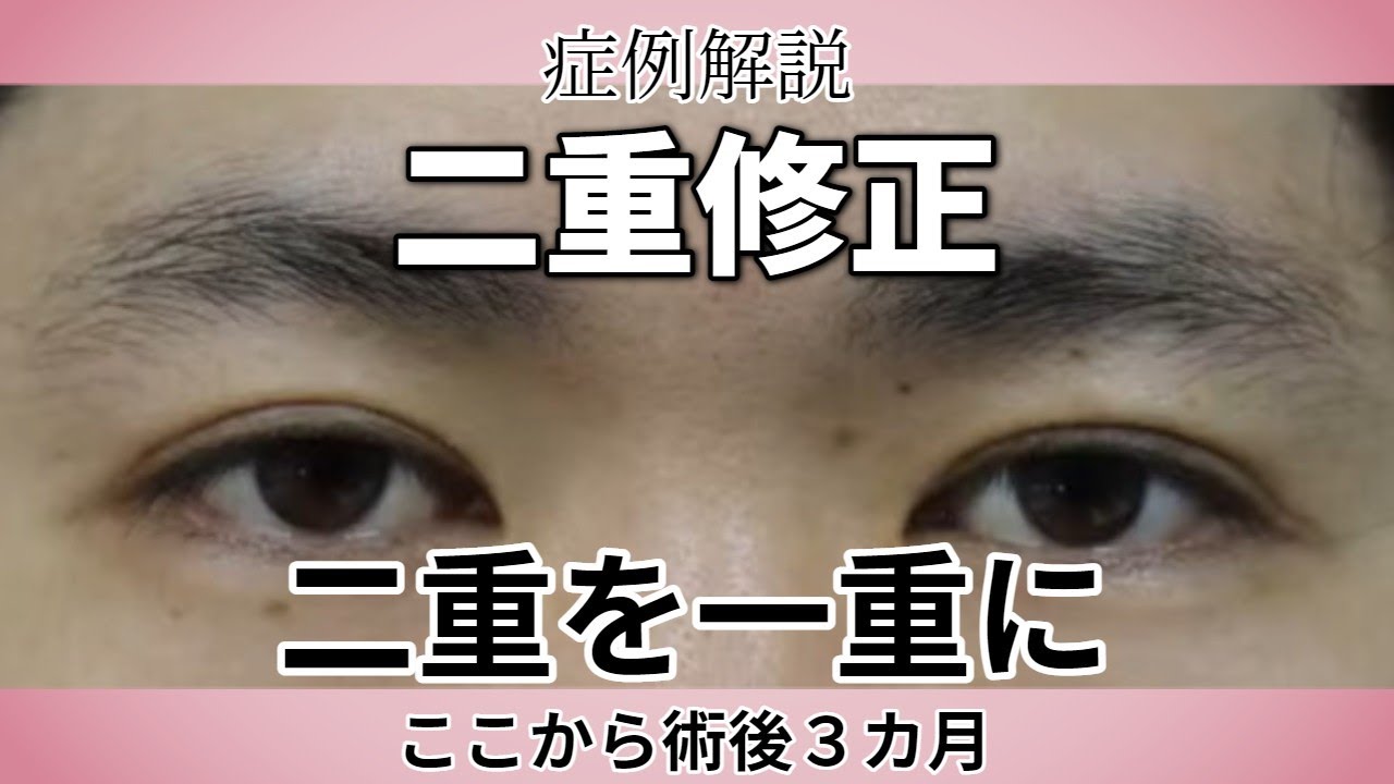 二重瞼から一重瞼への修正する整形手術／愛知県こいずみ形成クリニック - YouTube
