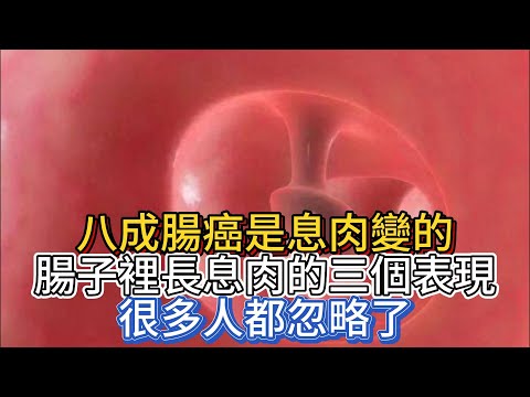 八成腸癌是息肉變的，腸子里長息肉的三個表現，很多人都忽略了