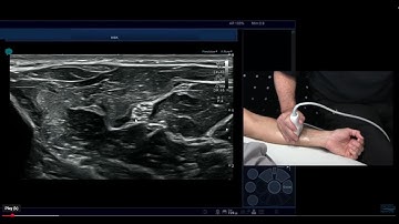 Peripheral Nerves Sonography: Intro Ultrasound and EMG Concepts- SAMPLE