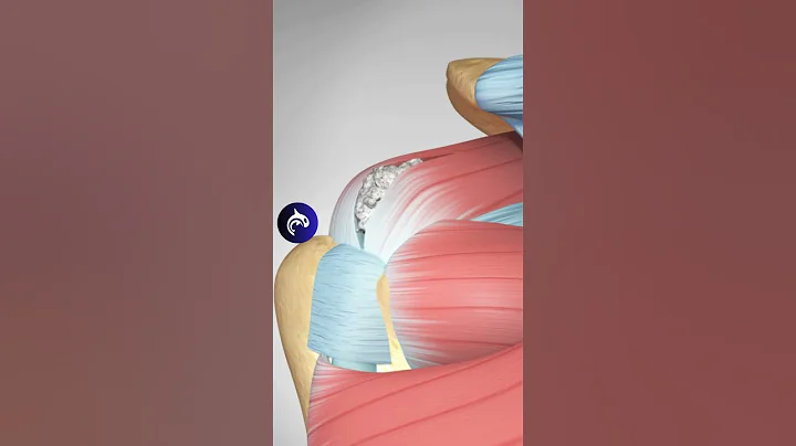 Nighttime Shoulder Pain? It Might Be Calcific Tendonitis (Calcium Deposits in your Tendon)