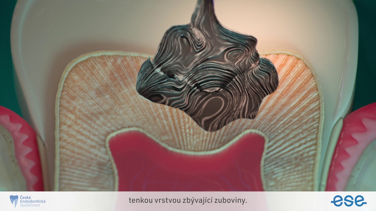 Vital Pulp Treatment - Czech version