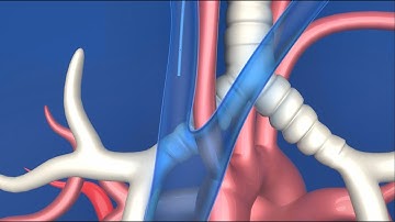 Arrow® PICC preloaded with the NaviCurve™ Stylet Experience Video