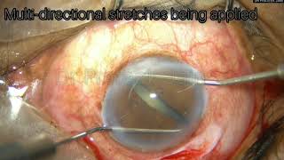 Msics With Stretch Pupilloplasty