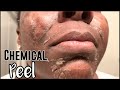 CHEMICAL PEEL FOR DARK SPOTS | How to Get Rid of Hyperpigmentation on Dark Skin & Dark Spots | PT 1