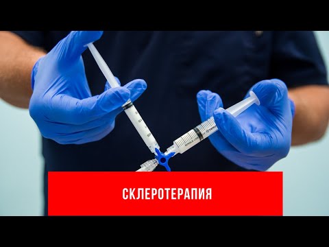 Все о склеротерапии