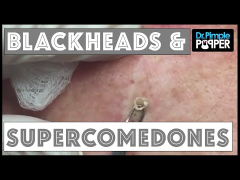 Blackhead Supercomedone Extractions: Dr Pimple Popper