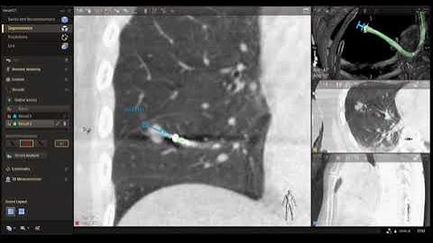 Tool in Lesion Segmentation