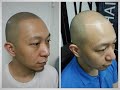 Jason&#39;s Scalp Micro Pigmentation (SMP) treatment experience in Hong Kong Eng.