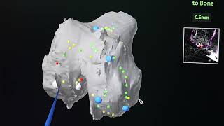 589 Robotic-Assisted Revision TKR for Failed Unicondylar Knee Replacement