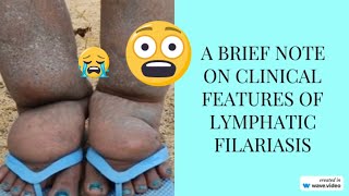 Discover The Surprising Clinical Features Of Lymphatic Filariasis Lymphatic Filariasis