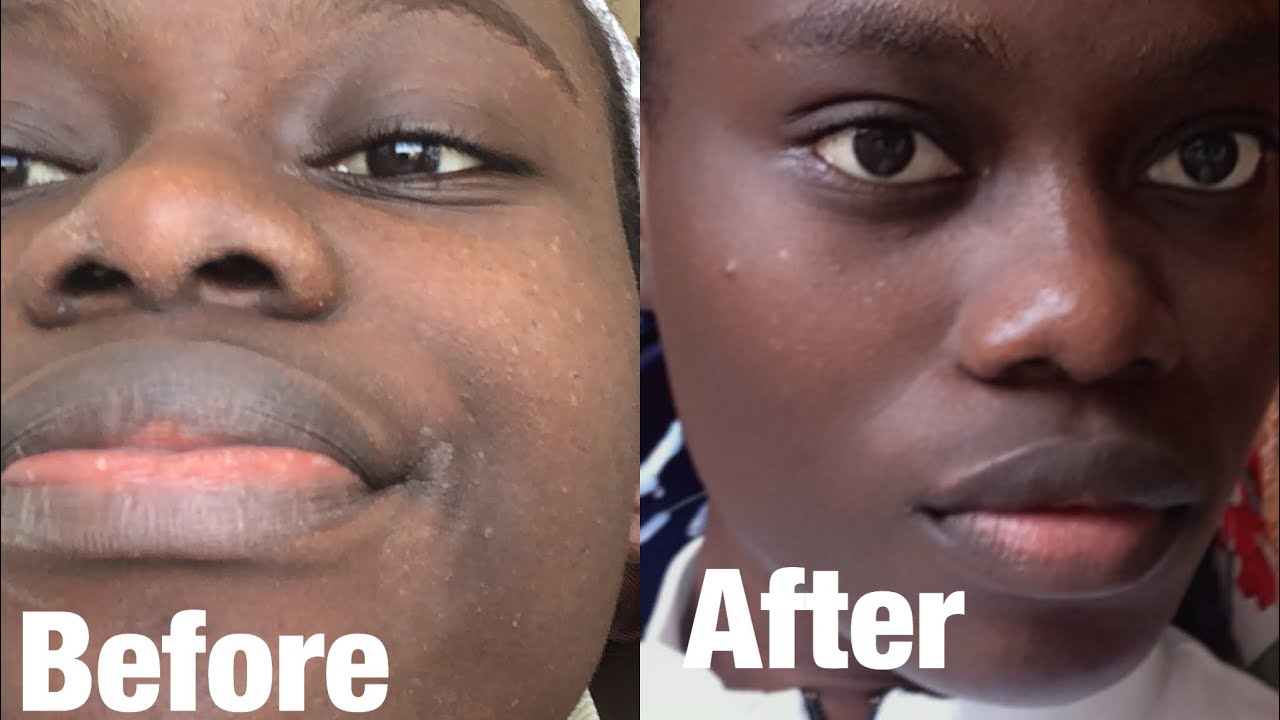 SKIN CARE; SHEA BUTTER AS A REMEDY FOR CORTICOSTEROID SIDE EFFECTS