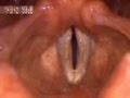 cuerdas vocales normales