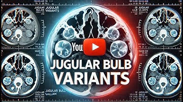 📢 CT Findings of Jugular Bulb Variants & Pulsatile Tinnitus 🏥🔬