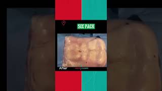 إحدى نتائج عملية عضلات البطن _(Six pack)