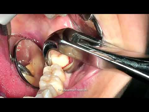 Gentle and fast lower wisdom tooth extraction