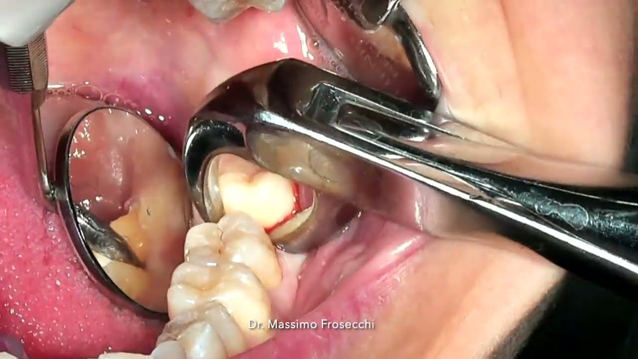 Gentle and fast lower wisdom tooth extraction