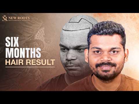 One Hair Transplant. One Incredible Transformation! 🔥 | Hair Transplant in Bangalore | New Roots