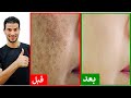 وصفة مذهلة للتخلص من تصبغات البشرة والبقع الداكنة في ايام 