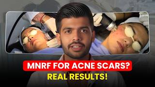 Best Treatment for Acne Scars? MNRF Session Step-by-Step | Clear Skin Clinic, Pune