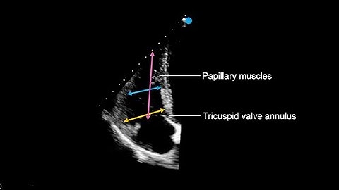 Measuring the right ventricle in echocardiography