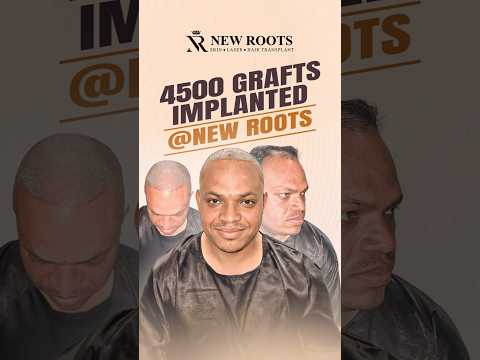 Hair Transplant in Raipur | 4500 Grafts Cost | Baldness Treatment #baldness #shorts #ytshorts