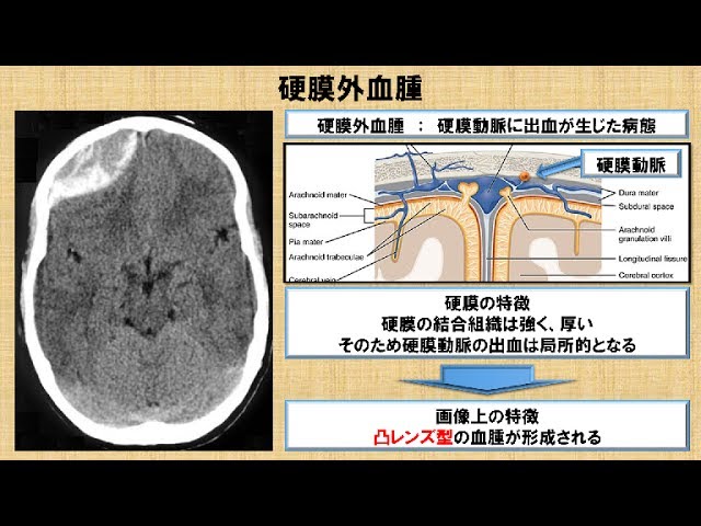 Ctの特徴及び脳画像の診方 No 43 理学療法士国家試験対策 シリーズ Youtube