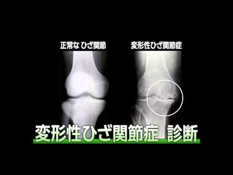 【変形性膝関節症】 特集企画「医療のチカラ」 変形性ひざ関節症