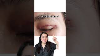 Keloid Scars See How Be Better Silicone Gel Sheets Transform Your Skin