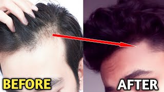 Regrow Hairline | Hair Regrowth For Men Naturally | Stop Hairloss And Receding Hairline | Hindi